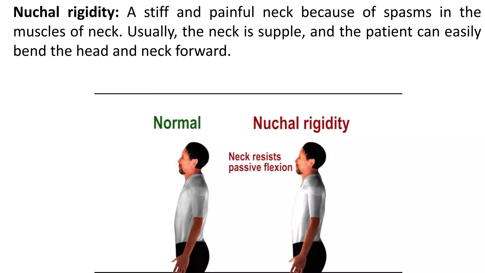 Nuchal rigidity: A stiff and painful neck because of spasms in the
muscles of neck. Usually, the neck is supple, and the patient can easily
bend the head and neck forward.
 