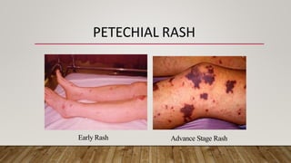 N Meningitis Rash meningitis-dr_tayyaba_21115525166616777200272-808.pptx