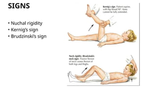 MENINGITIS general medicine seminar powerpoint | PPTX