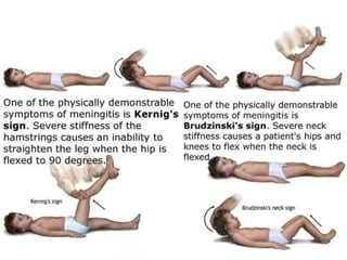 Bernigs Sign Comprehensive overview of Meningitis and its management | PPTX
