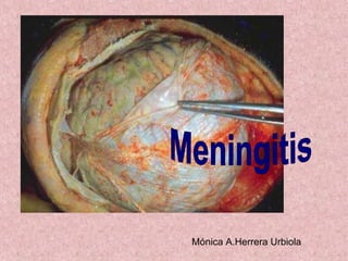 Mónica A.Herrera Urbiola Meningitis 