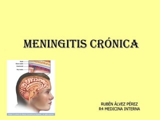 MENINGITIS CRÓNICA RUBÉN ÁLVEZ PÉREZ R4 MEDICINA INTERNA 