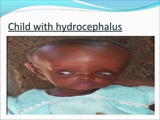 Child with hydrocephalus

 