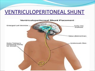 VENTRICULOPERITONEAL SHUNT

 