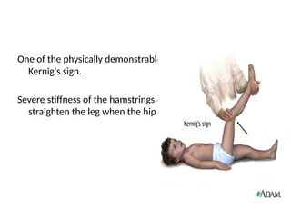 One of the physically demonstrable sign of meningitis is
Kernig's sign.
Severe stiffness of the hamstrings causes an inability to
straighten the leg when the hip is flexed to 90 degrees.
 