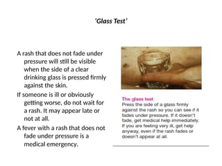 ‘Glass Test’
A rash that does not fade under
pressure will still be visible
when the side of a clear
drinking glass is pressed firmly
against the skin.
If someone is ill or obviously
getting worse, do not wait for
a rash. It may appear late or
not at all.
A fever with a rash that does not
fade under pressure is a
medical emergency.
 