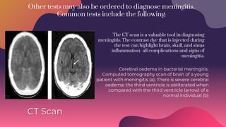 Other tests may also be ordered to diagnose meningitis.
Common tests include the following:
CT Scan
Cerebral oedema in bacterial meningitis.
Computed tomography scan of brain of a young
patient with meningitis (a). There is severe cerebral
oedema: the third ventricle is obliterated when
compared with the third ventricle (arrow) of a
normal individual (b)
The CT scan is a valuable tool in diagnosing
meningitis. The contrast dye that is injected during
the test can highlight brain, skull, and sinus
inflammation- all complications and signs of
meningitis.
 