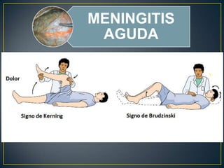 MENINGITIS
AGUDA

 