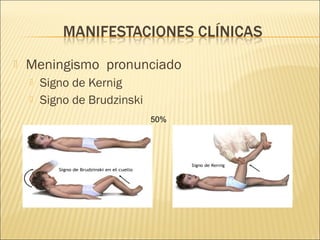  Meningismo pronunciado
 Signo de Kernig
 Signo de Brudzinski
50%
 