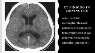 CT FINDING IN
MENINGITIS
Acute bacterial
meningitis. This axial
nonenhanced computed
tomography scan shows
mild ventriculomegaly
and sulcal effacement.
 