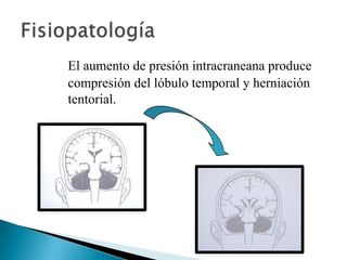 El aumento de presión intracraneana produce
compresión del lóbulo temporal y herniación
tentorial.

 