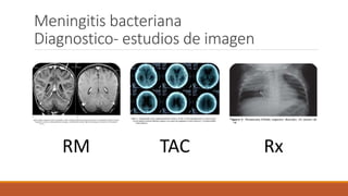 Meningitis bacteriana en pediatría | PPTX