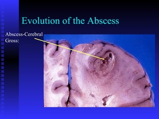 BACTERIAL MENINGITIS BY DR BASHIR AHMED DAR ASSOCIATE PROFESSOR ...