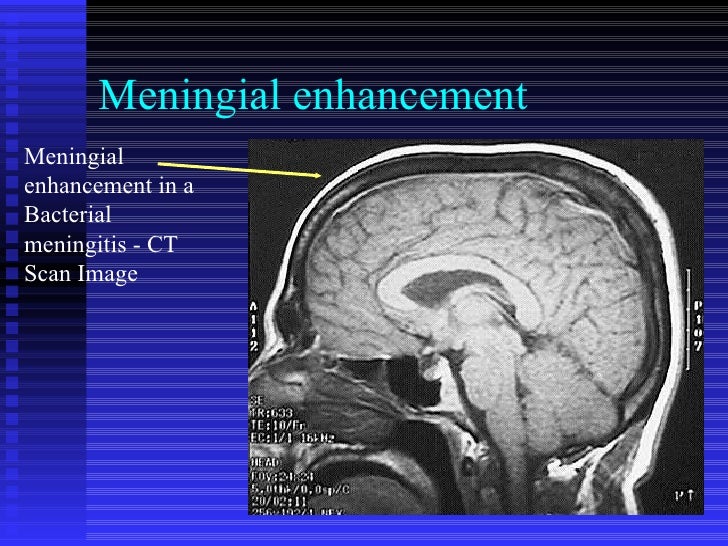 BACTERIAL MENINGITIS BY DR BASHIR AHMED DAR ASSOCIATE PROFESSOR MEDIC…