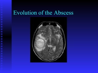 VIRAL MENINGITIS BY DR BASHIR AHMED DAR ASSOCIATE PROFESSOR MEDICINE ...