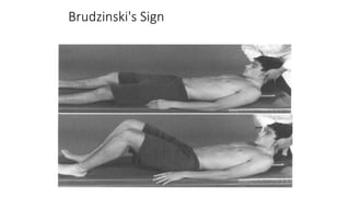 Brudzinski's Sign
 