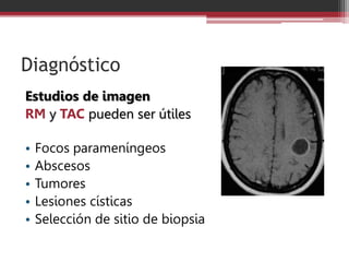 Diagnóstico
Estudios de imagen
RM y TAC pueden ser útiles
• Focos parameníngeos
• Abscesos
• Tumores
• Lesiones císticas
• Selección de sitio de biopsia
 