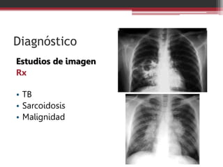 Diagnóstico
Estudios de imagen
Rx
• TB
• Sarcoidosis
• Malignidad
 