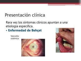Presentación clínica
Rara vez los síntomas clínicos apuntan a una
etiología específica.
• Enfermedad de Behçet
Vasculitis
sistémica
 