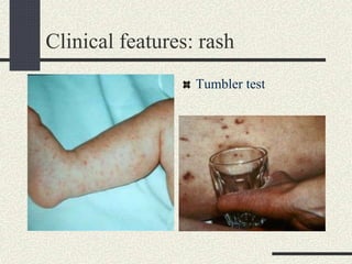 Clinical features: rash
Tumbler test
 