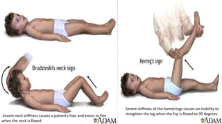 Severe stiffness of the hamstrings causes an inability to
straighten the leg when the hip is flexed to 90 degrees.
.Severe neck stiffness causes a patient's hips and knees to flex
when the neck is flexed
 