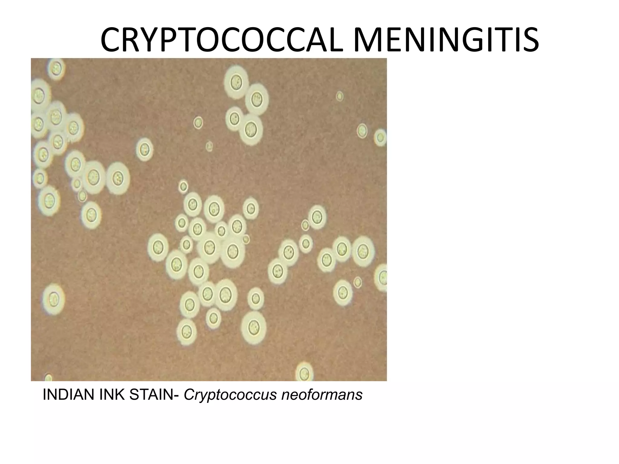 CRYPTOCOCCAL MENINGITIS
7 March 2023 MENINGITIS 32
INDIAN INK STAIN- Cryptococcus neoformans
 