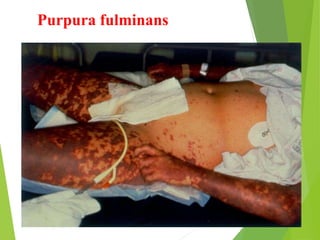 Purpura fulminans
 