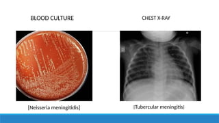 BLOOD CULTURE CHEST X-RAY
[Neisseria meningitidis] [Tubercular meningitis]
 