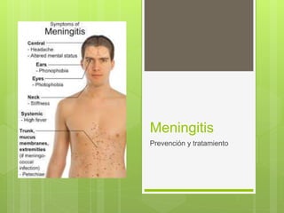 Meningitis
Prevención y tratamiento
 