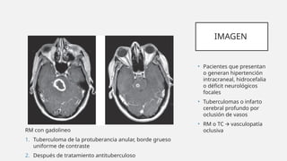 IMAGEN
• Pacientes que presentan
o generan hipertención
intracraneal, hidrocefalia
o déficit neurológicos
focales
• Tuberculomas o infarto
cerebral profundo por
oclusión de vasos
• RM o TC vasculopatía
🡪
oclusiva
RM con gadolineo
1. Tuberculoma de la protuberancia anular, borde grueso
uniforme de contraste
2. Después de tratamiento antituberculoso
 