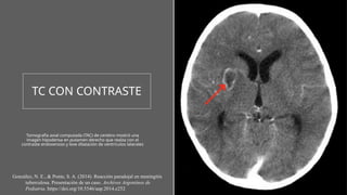 TC CON CONTRASTE
Tomografía axial computada (TAC) de cerebro mostró una
imagen hipodensa en putamen derecho que realza con el
contraste endovenoso y leve dilatación de ventrículos laterales
González, N. E., & Ponte, S. A. (2014). Reacción paradojal en meningitis
tuberculosa. Presentación de un caso. Archivos Argentinos de
Pediatria. https://doi.org/10.5546/aap.2014.e252
 