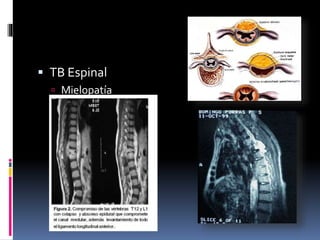  TB Espinal
 Mielopatía
 Osteomielitis
 Mielitis transversa
 Radiculomielopatía
 