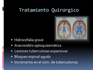 Tratamiento Quirúrgico
 Hidrocefalia grave
 Aracnoiditis optoquiasmática
 Lesiones tuberculosas expansivas
 Bloqueo espinal agudo
 Incremento en el núm. de tuberculomas
 