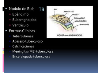 TB en SNC Nodulo de Rich
 Epéndimo
 Subaragnoideo
 Ventriculo
 Formas Clínicas
 Tuberculomas
 Absceso tuberculoso
 Calcificaciones
 Meningitis (ME) tuberculosa
 Encefalopatía tuberculosa
 