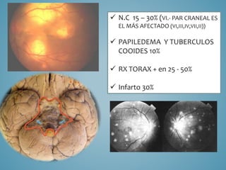  N.C 15 – 30% (VI.- PAR CRANEAL ES
EL MÁS AFECTADO (VI,III,IV,VII,II))
 PAPILEDEMA Y TUBERCULOS
COOIDES 10%
 RX TORAX + en 25 - 50%
 Infarto 30%
 