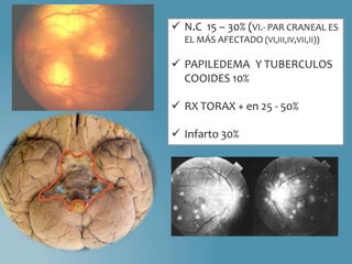  N.C 15 – 30% (VI.- PAR CRANEAL ES
EL MÁS AFECTADO (VI,III,IV,VII,II))
 PAPILEDEMA Y TUBERCULOS
COOIDES 10%
 RX TORAX + en 25 - 50%
 Infarto 30%
 