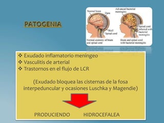  Exudado inflamatorio meningeo
 Vasculitis de arterial
 Trastornos en el flujo de LCR
(Exudado bloquea las cisternas de la fosa
interpeduncular y ocasiones Luschka y Magendie)
PRODUCIENDO HIDROCEFALEA
 