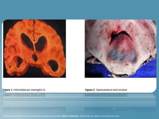 Tuberculosis del Sistema Nervioso.Central: Conceptos actuales.Dr. Héctor R. Martínez., Monterrey, N.L. México. Neurociencias 2000
 