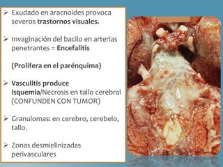  Exudado en aracnoides provoca
severos trastornos visuales.
 Invaginación del bacilo en arterias
penetrantes = Encefalitis
(Prolifera en el parénquima)
 Vasculitis produce
isquemia/Necrosis en tallo cerebral
(CONFUNDEN CON TUMOR)
 Granulomas: en cerebro, cerebelo,
tallo.
 Zonas desmielinizadas
perivasculares
 