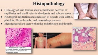 ● Histology of skin lesions shows endothelial necrosis of
capillaries and small veins in the dermis and subcutaneous tissue.
● Neutrophil infiltration and occlusion of vessels with WBCs,
platelets, fibrin thrombi, and hemorrhage are seen.
● Meningococci are seen within the endothelium and thrombi.
Histopathology
 