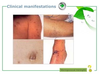 www.themegallery.com LOGO
Clinical manifestations
Meningococcal meningitis
 