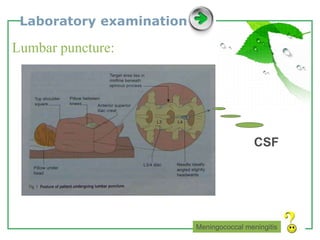 www.themegallery.com LOGO
Laboratory examination
Lumbar puncture:
Meningococcal meningitis
CSF
 