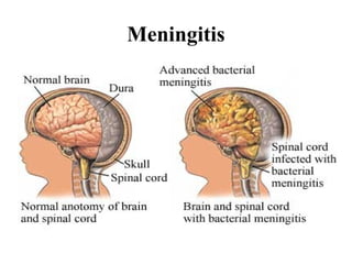 Meningitis
 