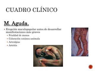 M. Aguda.
 Erupción maculopapular antes de desarrollar
manifestaciones más graves
 Frialdad de manos
 Coloración cutánea anómala
 Artralgias
 Artritis
 