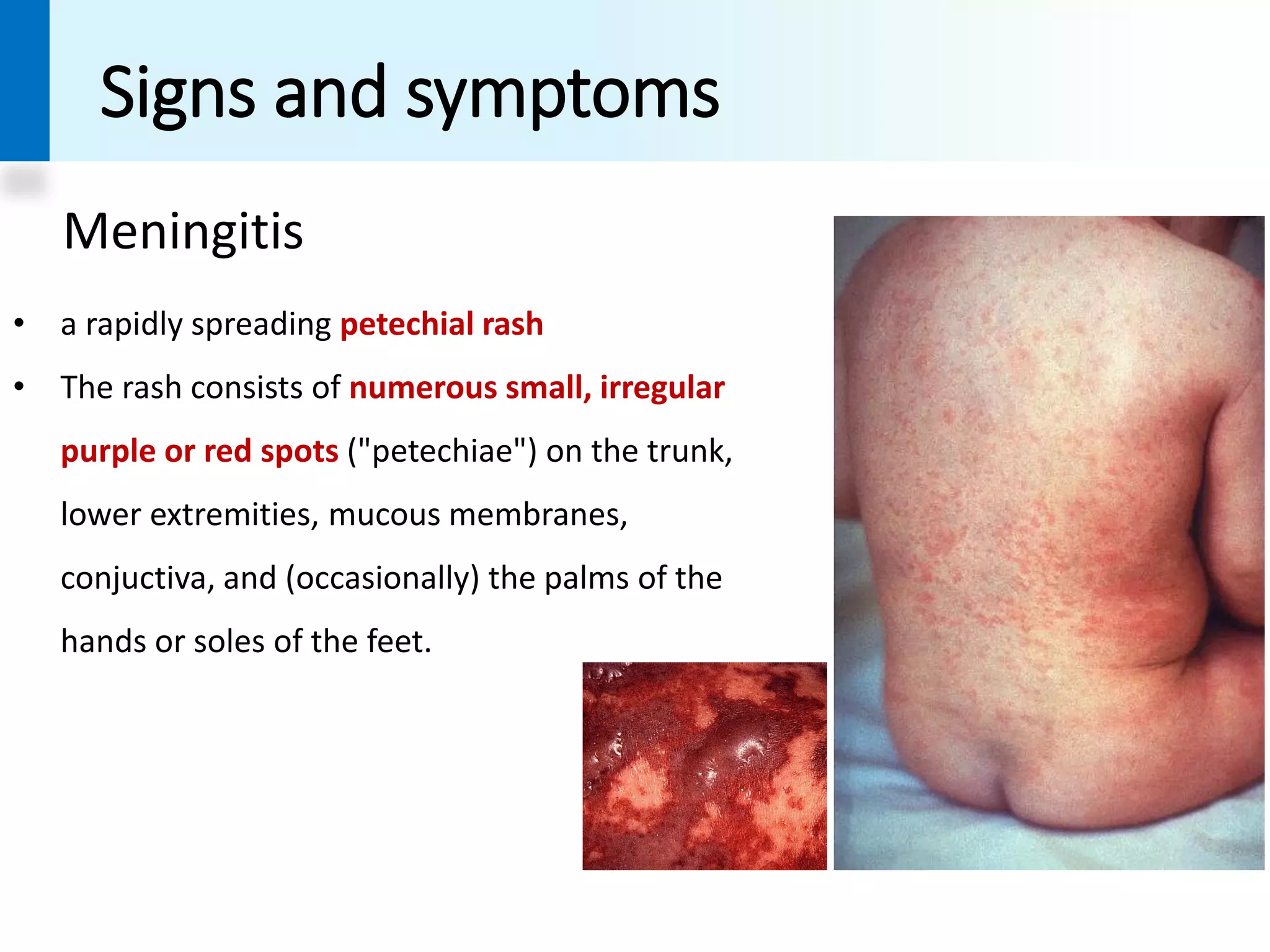 N Meningitis Rash Meningococci | PDF