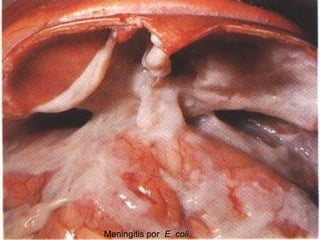 Meningitis por  E. coli 