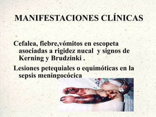 MANIFESTACIONES CLÍNICAS

Cefalea, fiebre,vómitos en escopeta
 asociadas a rigidez nucal y signos de
 Kerning y Brudzinki .
Lesiones petequiales o equimóticas en la
 sepsis meningocócica
 