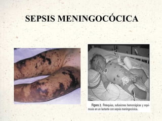 SEPSIS MENINGOCÓCICA
 