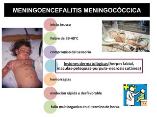 MENINGOENCEFALITIS MENINGOCÓCCICA
 
