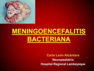 MENINGOENCEFALITIS
BACTERIANA
Carla León Alcántara
Neuropediatria
Hospital Regional Lambayeque
 